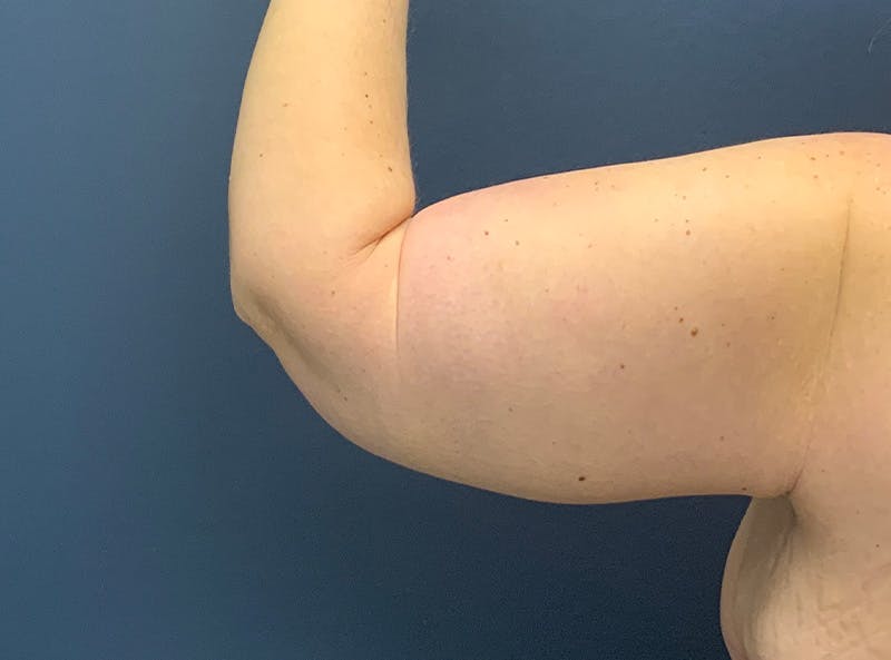 Arm Lift Before & After Gallery - Patient 275696 - Image 4