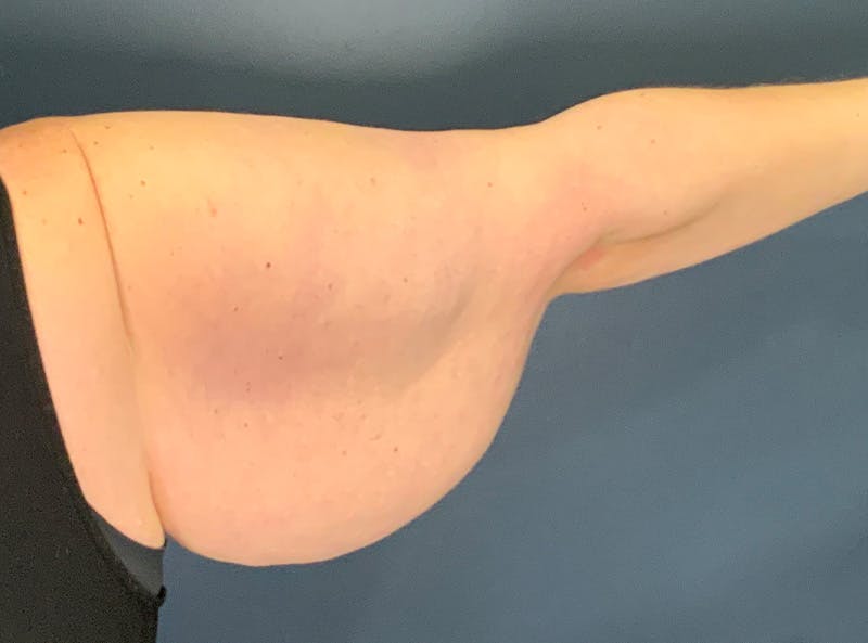 Arm Lift Before & After Gallery - Patient 275696 - Image 5