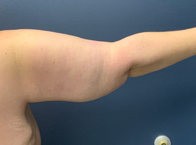 Arm Lift Before & After Gallery - Patient 275696 - Image 6