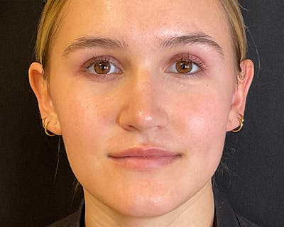 Rhinoplasty Before & After Gallery - Patient 212112 - Image 2