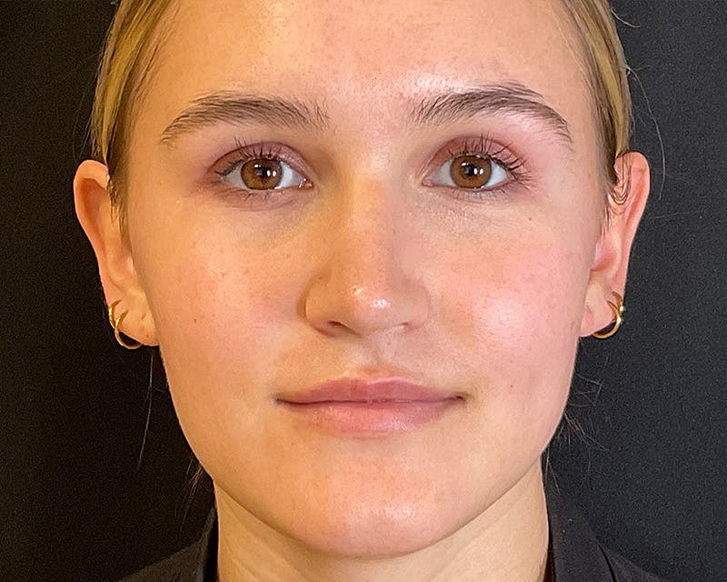 Rhinoplasty Before & After Gallery - Patient 212112 - Image 2
