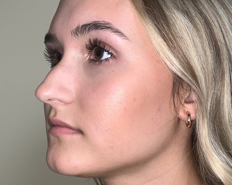 Rhinoplasty Before & After Gallery - Patient 212112 - Image 3