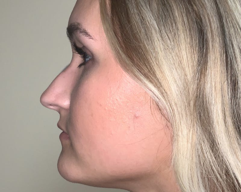 Rhinoplasty Before & After Gallery - Patient 212112 - Image 5