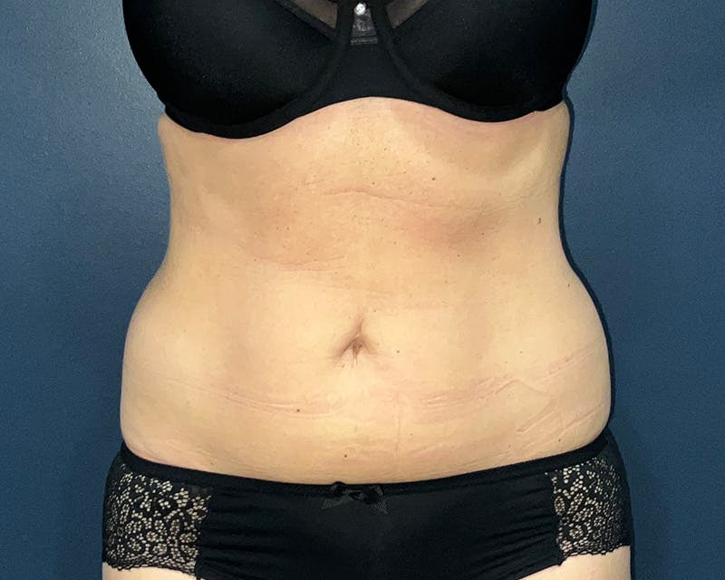 Liposuction Before & After Gallery - Patient 216072 - Image 1