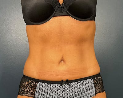 Liposuction Before & After Gallery - Patient 216072 - Image 2