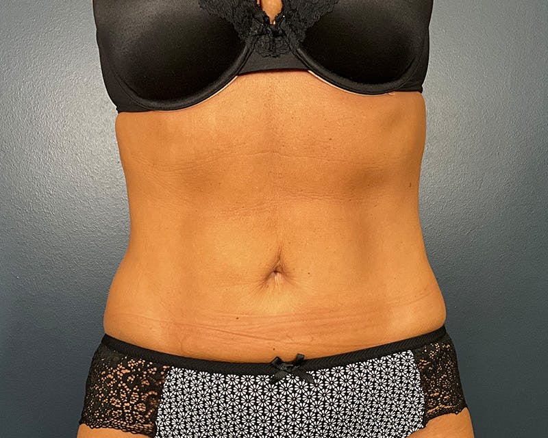 Liposuction Before & After Gallery - Patient 216072 - Image 2
