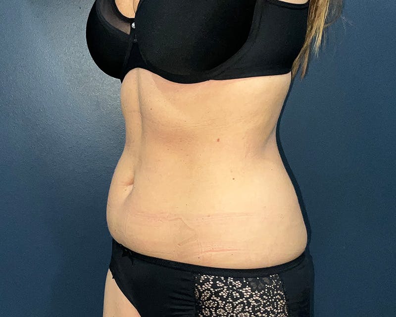Liposuction Before & After Gallery - Patient 216072 - Image 3