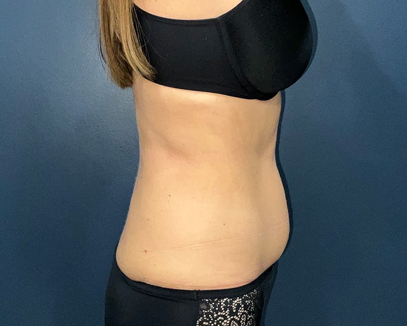 Liposuction Before & After Gallery - Patient 216072 - Image 5