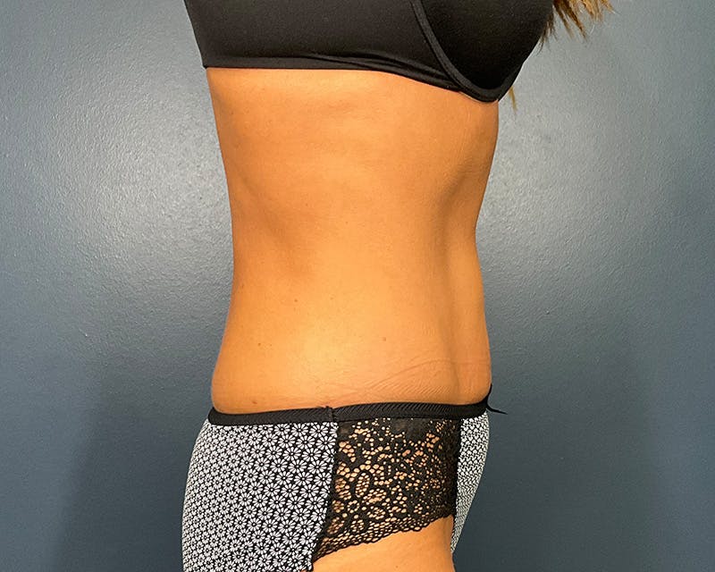 Liposuction Before & After Gallery - Patient 216072 - Image 6