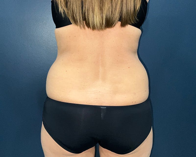 Liposuction Before & After Gallery - Patient 216072 - Image 7