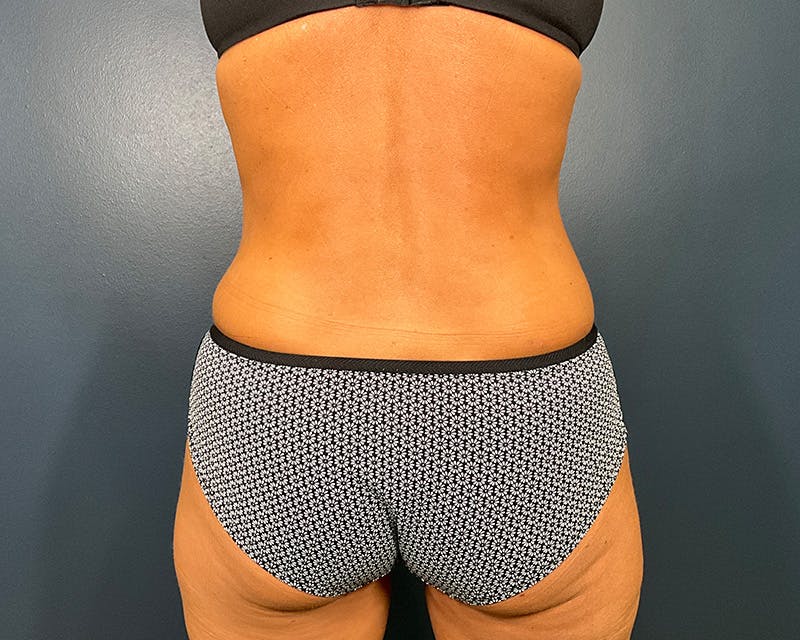 Liposuction Before & After Gallery - Patient 216072 - Image 8