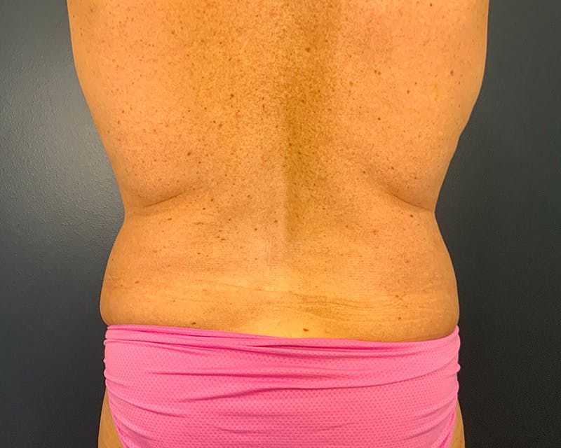 Mommy Makeover Before & After Gallery - Patient 112083 - Image 9