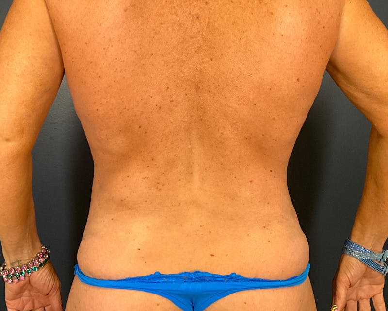 Mommy Makeover Before & After Gallery - Patient 112083 - Image 10