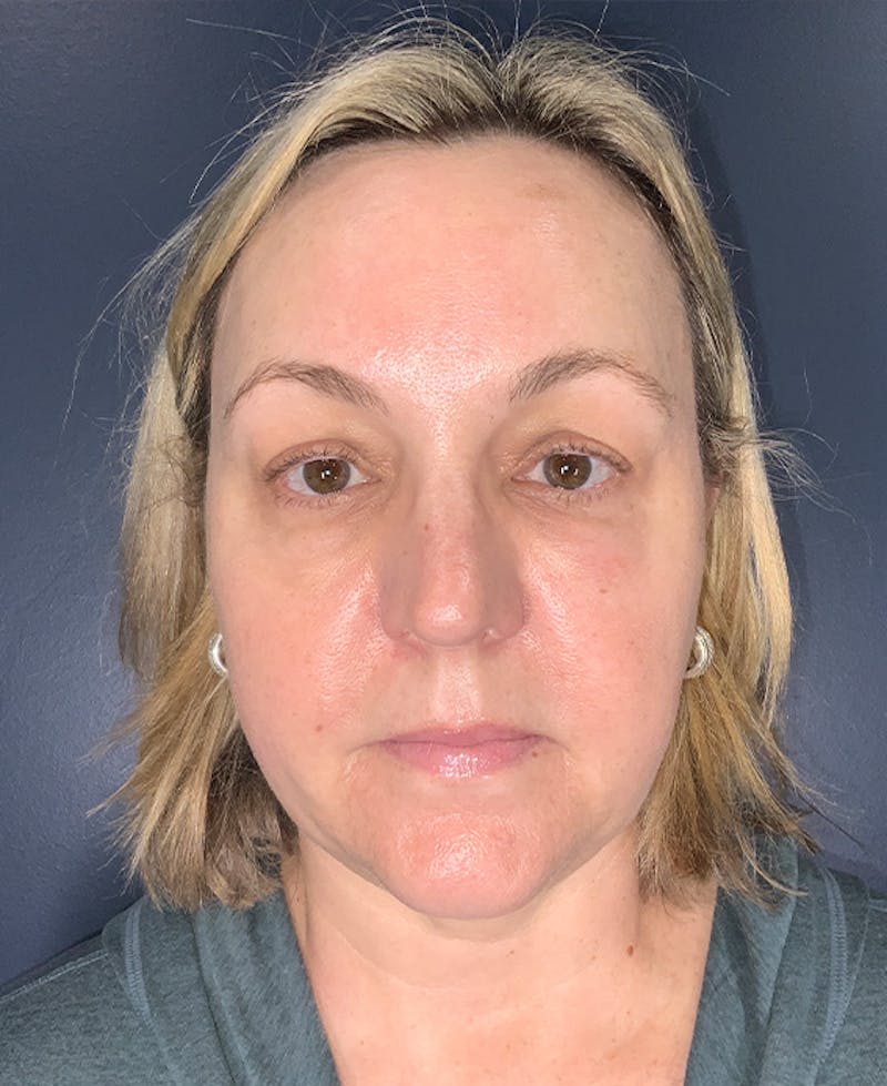 Blepharoplasty Before & After Gallery - Patient 255215 - Image 1