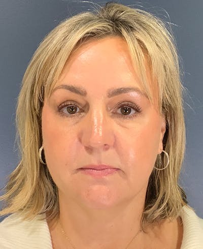Blepharoplasty Before & After Gallery - Patient 255215 - Image 2