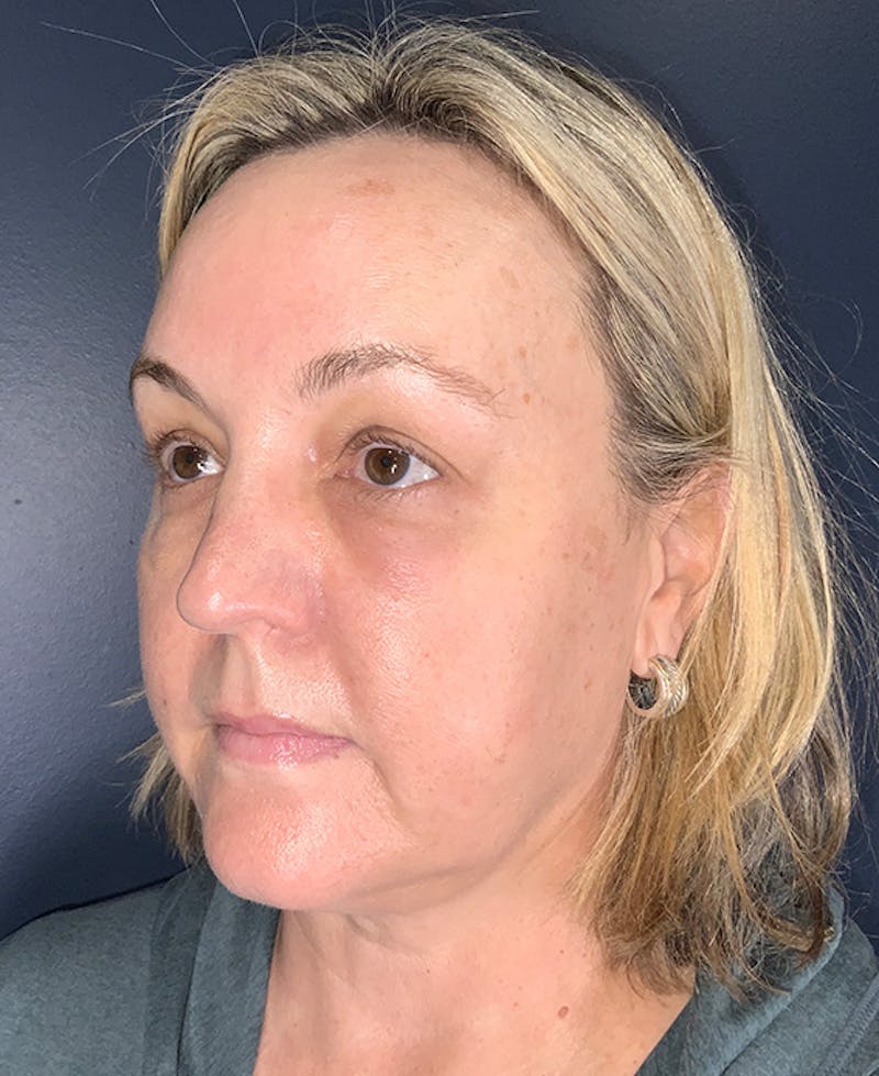 Blepharoplasty Before & After Gallery - Patient 255215 - Image 3