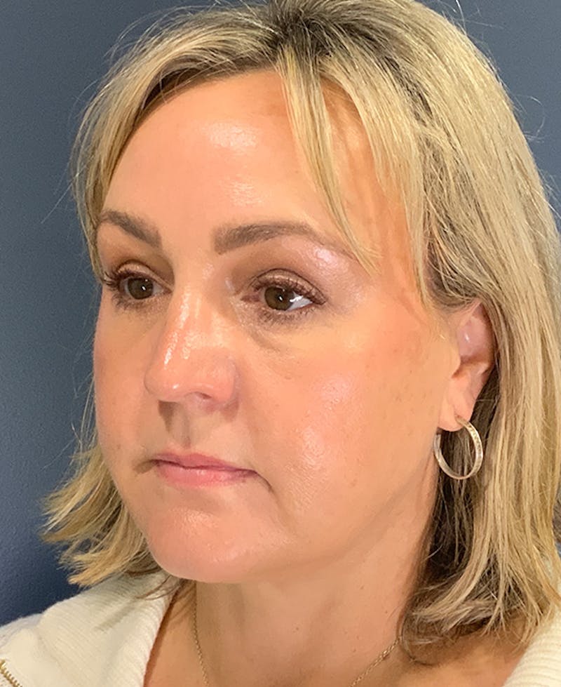 Blepharoplasty Before & After Gallery - Patient 255215 - Image 4
