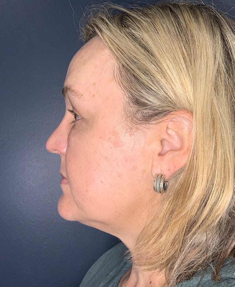 Blepharoplasty Before & After Gallery - Patient 255215 - Image 5