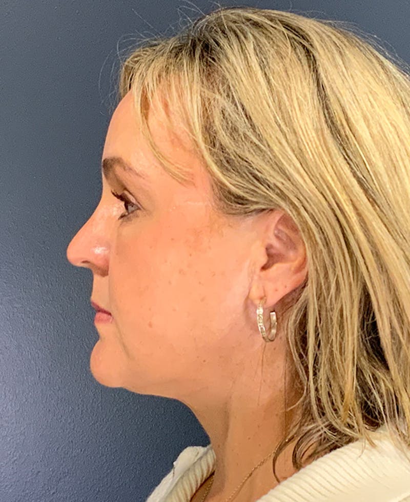 Blepharoplasty Before & After Gallery - Patient 255215 - Image 6