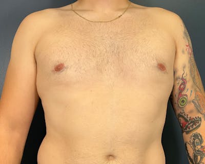 Male Breast Reduction Before & After Gallery - Patient 354535 - Image 2