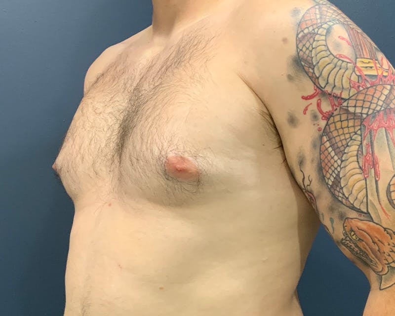 Male Breast Reduction Before & After Gallery - Patient 354535 - Image 3