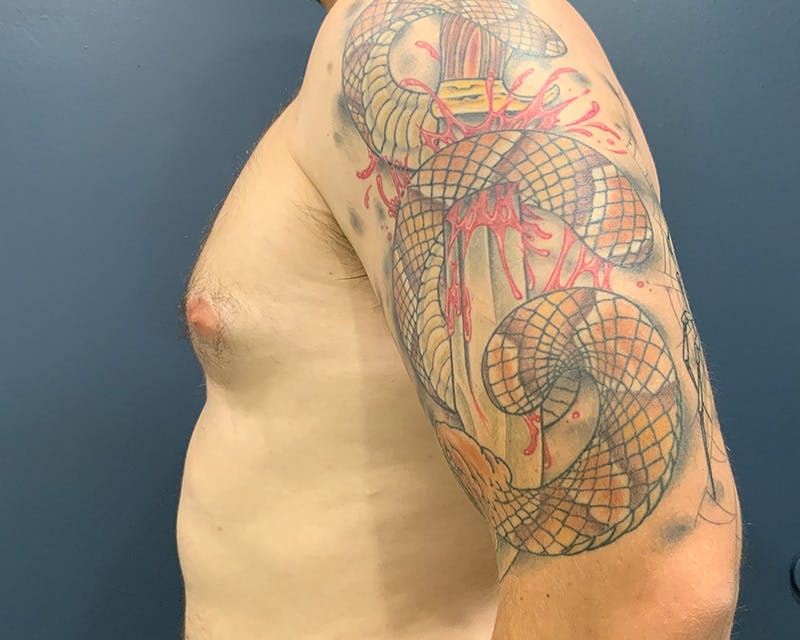 Male Breast Reduction Before & After Gallery - Patient 354535 - Image 5