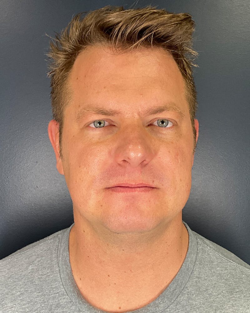 Neck Liposuction Before & After Gallery - Patient 214836 - Image 2