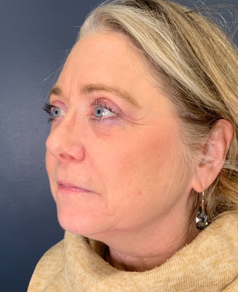 Blepharoplasty Before & After Gallery - Patient 334669 - Image 8