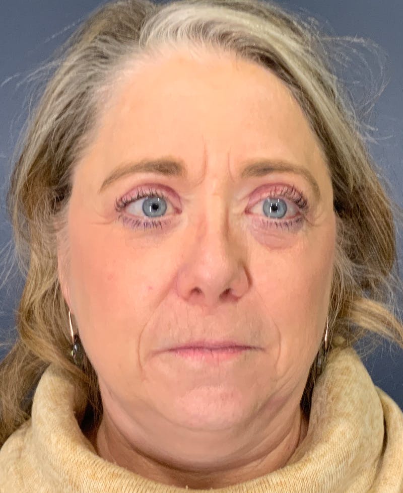 Blepharoplasty Before & After Gallery - Patient 334669 - Image 2