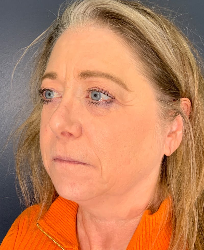Blepharoplasty Before & After Gallery - Patient 334669 - Image 7