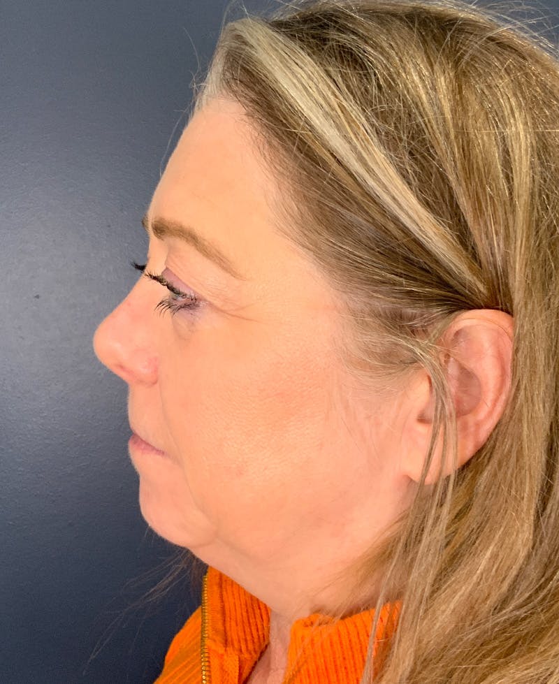 Blepharoplasty Before & After Gallery - Patient 334669 - Image 9