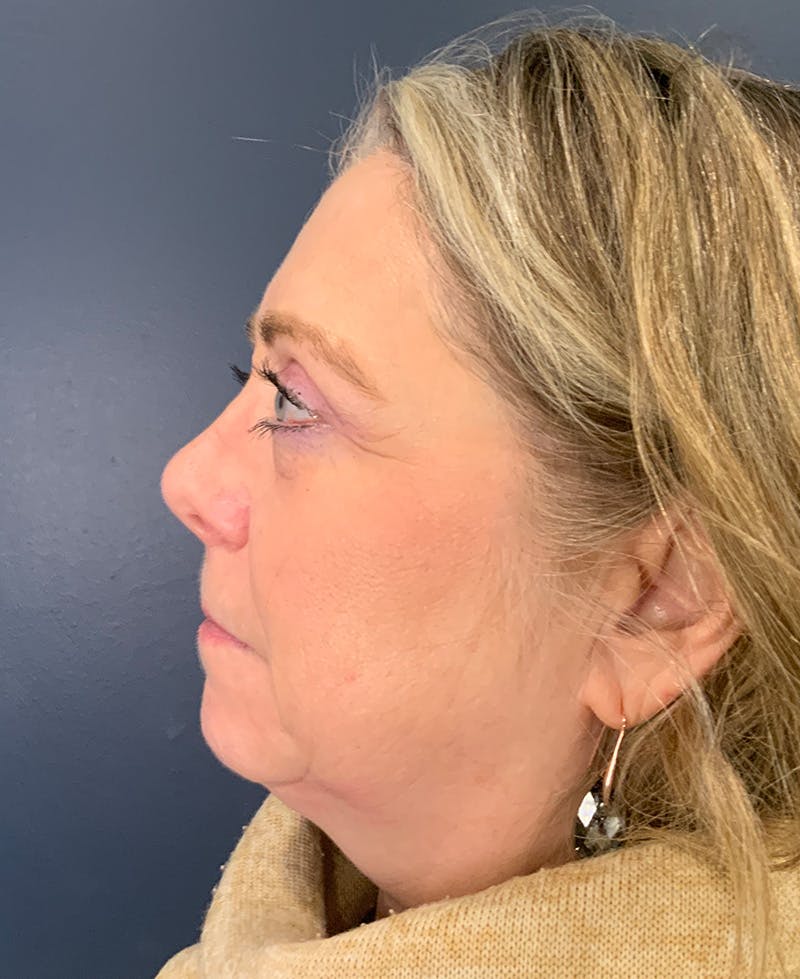Blepharoplasty Before & After Gallery - Patient 334669 - Image 10