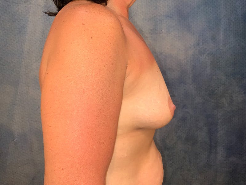 Breast Augmentation Before & After Gallery - Patient 217207 - Image 3