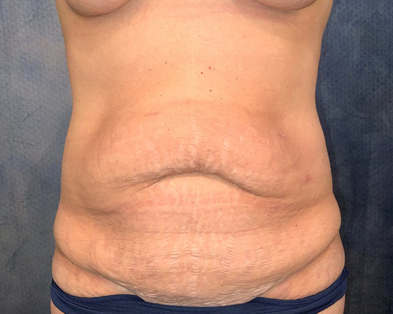 Tummy Tuck Before & After Gallery - Patient 182694 - Image 1