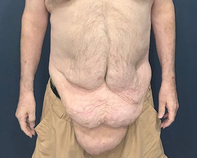 Massive Weight Loss Procedures Before & After Gallery - Patient 530051 - Image 1