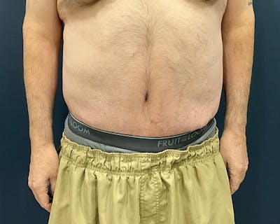 Massive Weight Loss Procedures Before & After Gallery - Patient 530051 - Image 2