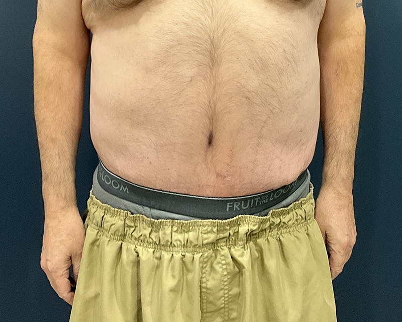 Massive Weight Loss Procedures Before & After Gallery - Patient 530051 - Image 2