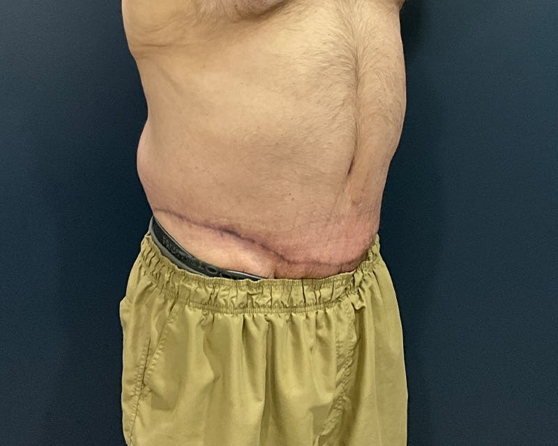 Massive Weight Loss Procedures Before & After Gallery - Patient 530051 - Image 4