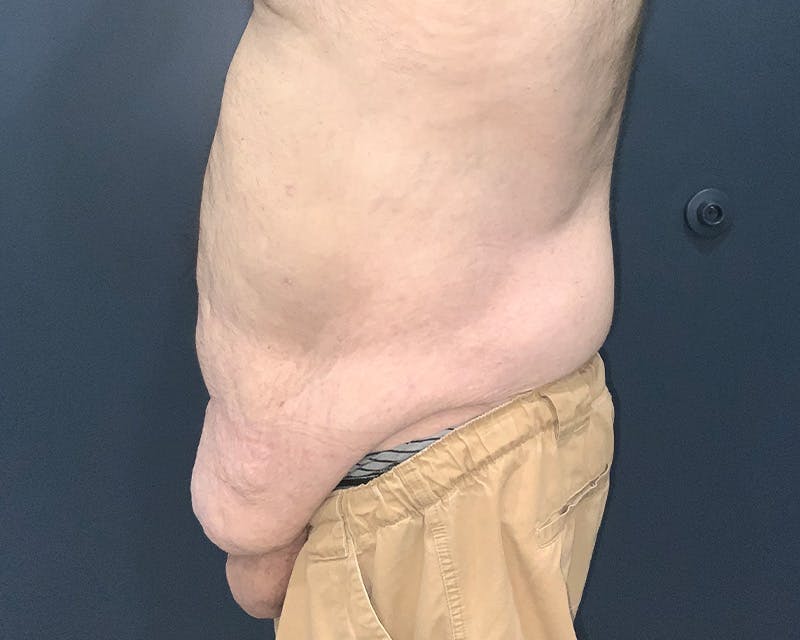 Massive Weight Loss Procedures Before & After Gallery - Patient 530051 - Image 5