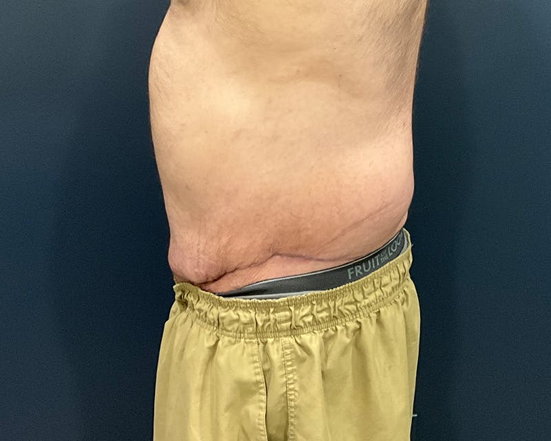 Massive Weight Loss Procedures Before & After Gallery - Patient 530051 - Image 6
