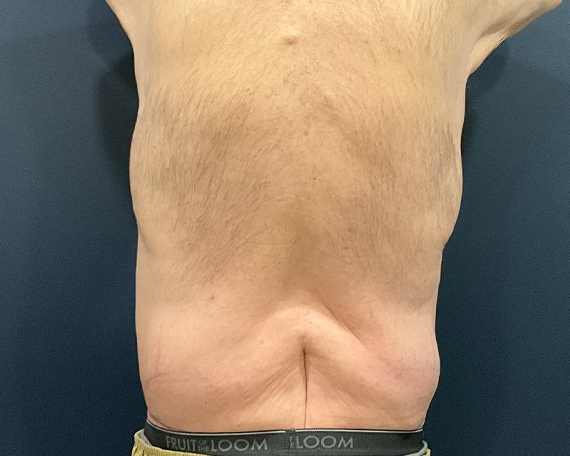 Massive Weight Loss Procedures Before & After Gallery - Patient 530051 - Image 8