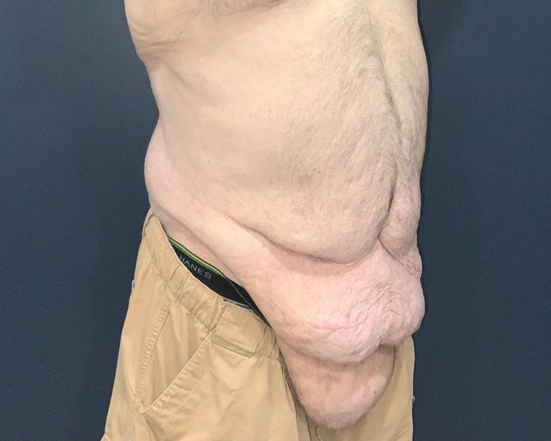 Massive Weight Loss Procedures Before & After Gallery - Patient 530051 - Image 3
