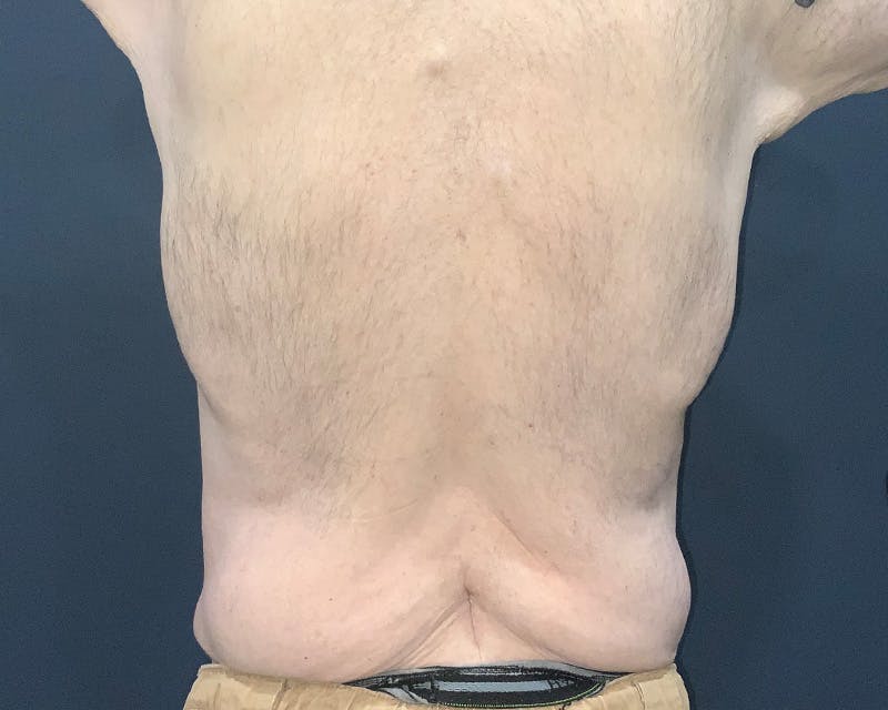 Massive Weight Loss Procedures Before & After Gallery - Patient 530051 - Image 7