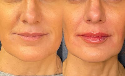 Restylane Before & After Gallery - Patient 226991 - Image 1