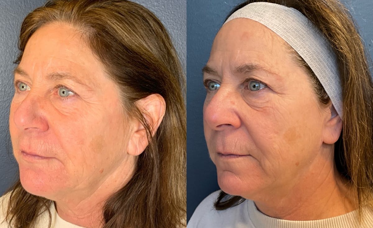 Dermal Filler Before & After Gallery - Patient 122144 - Image 4