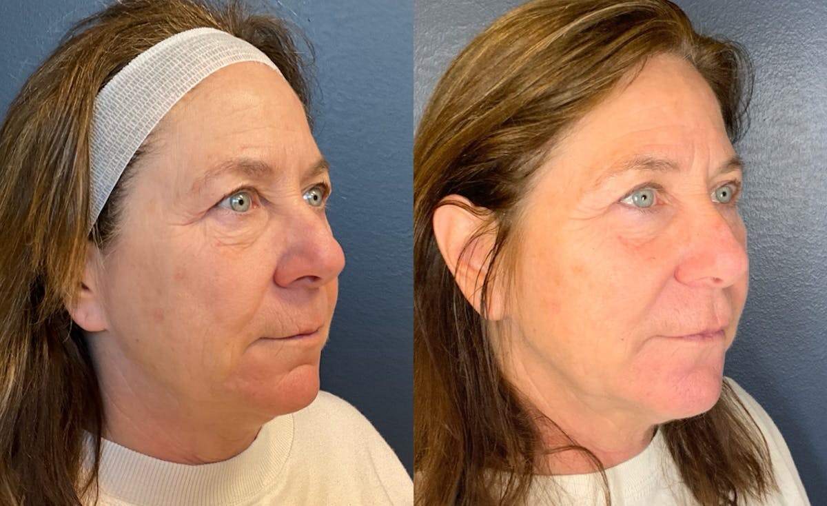 Dermal Filler Before & After Gallery - Patient 122144 - Image 3