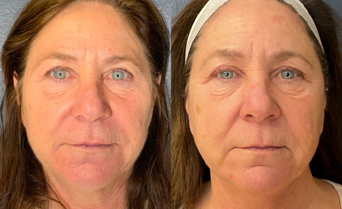 Dermal Filler Before & After Gallery - Patient 122144 - Image 2
