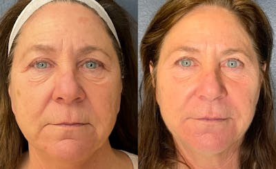 Dermal Filler Before & After Gallery - Patient 122144 - Image 1