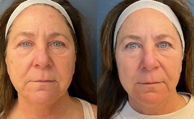 HALO laser Before & After Gallery - Patient 244620 - Image 1