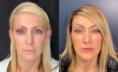 Sculptra Before & After Gallery - Patient 455043 - Image 1